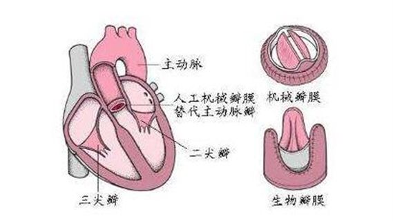 三尖瓣狭窄简介