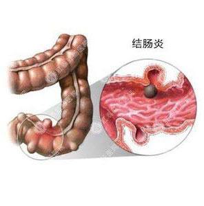 慢性结肠炎