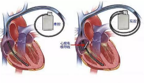 心脏起搏器植入术