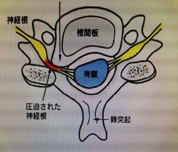 神经根型颈椎病