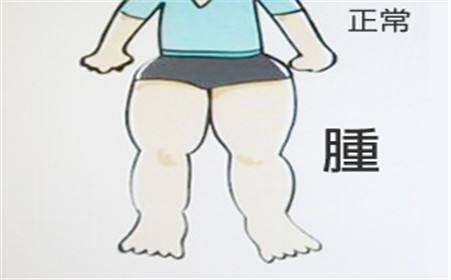 淋巴水肿