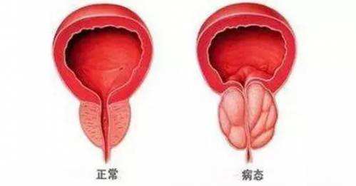 尿道息肉
