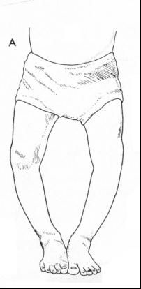 O型腿