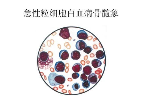 急性粒细胞白血病
