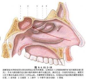 鼻骨瘤