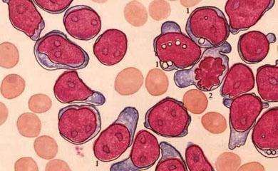 急性单核细胞白血病