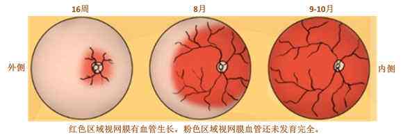 早产儿视网膜病变