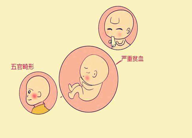 胎儿先天畸形