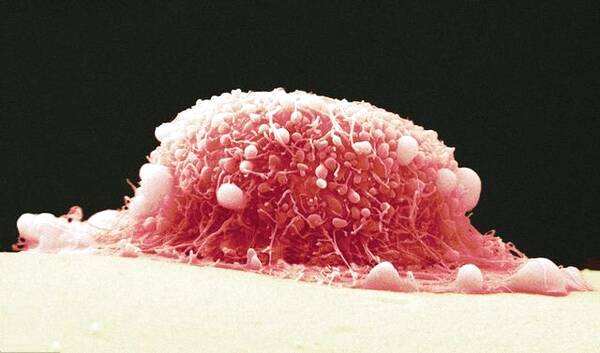 宫颈鳞状细胞癌
